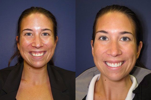 Cosmetic Porcelain Veneers: 6 Cosmetic Empress Veneers achieving straight non crowded teeth
