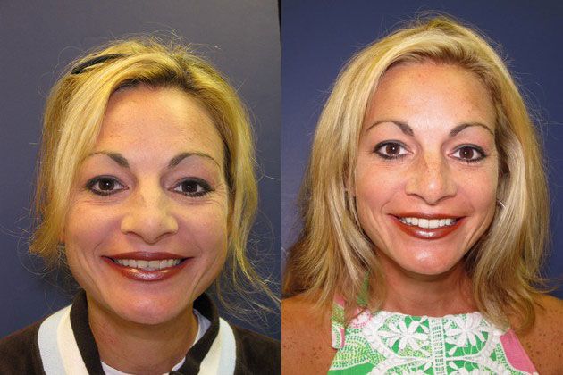 Cosmetic Porcelain Veneers: 6 upper cosmetic dental veneers