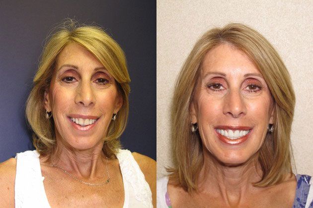 Cosmetic Porcelain Veneers: Brighten your stained yellow teeth
