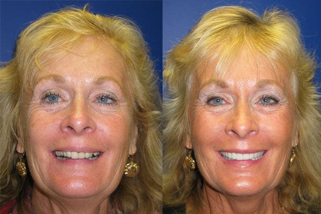 Complete Dental Restoration : Smile Lift/Complete Dental Restoration with Cosmetic Porcelain Crowns