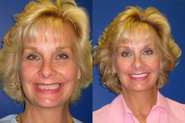 Smile Makeover / Smile Lift : Cosmetic Porcelain Veneers EMAX