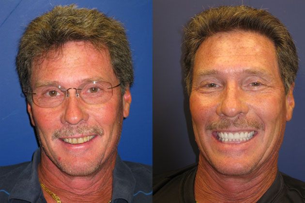 Complete Dental Restoration : Dental restoration with Empress Cosmetic Porcelain Crowns