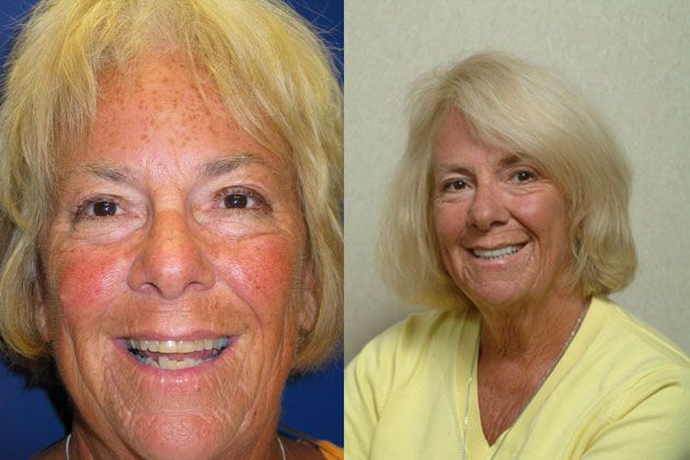 Complete Dental Restoration : Dental Restoration Metal Free Porcelain Crowns and Porcelain Veneers