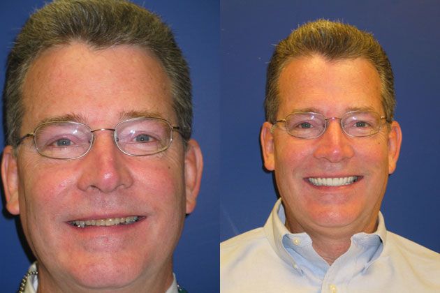 Complete Dental Restoration : Dental Restoration with Porcelain Crowns and Veneers
