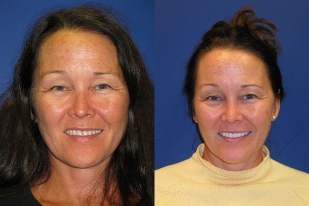 Cosmetic Porcelain Veneers: Do you want brighter prettier teeth?