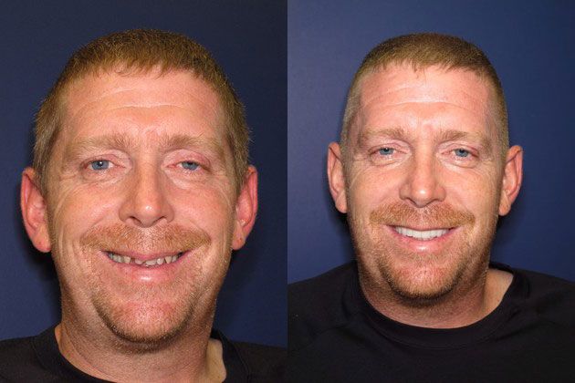 Full Mouth Restoration: EMAX Porcelain Crowns