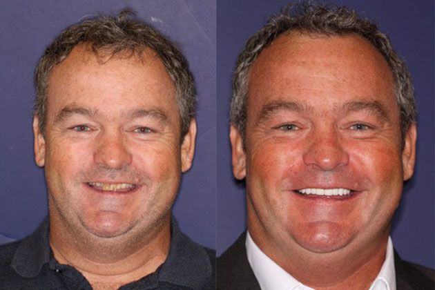 Full Mouth Restoration: Fixing chipped and cracked teeth