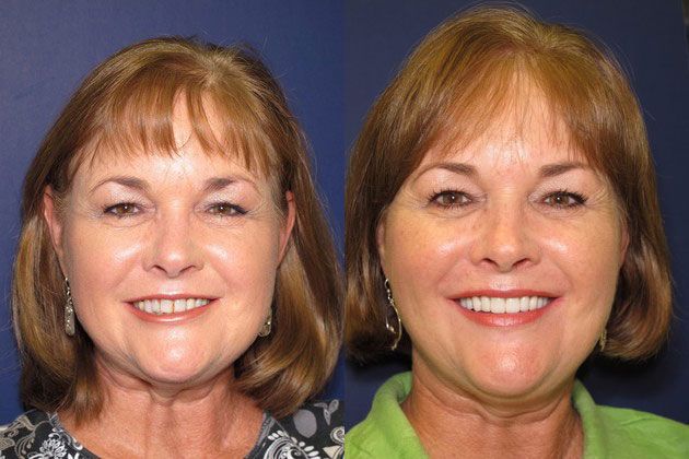 Full Mouth Restoration: Full mouth restoration balanced facial aesthetics