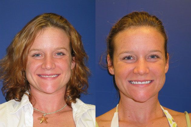 Cosmetic Porcelain Veneers: Look healthy and feel great
