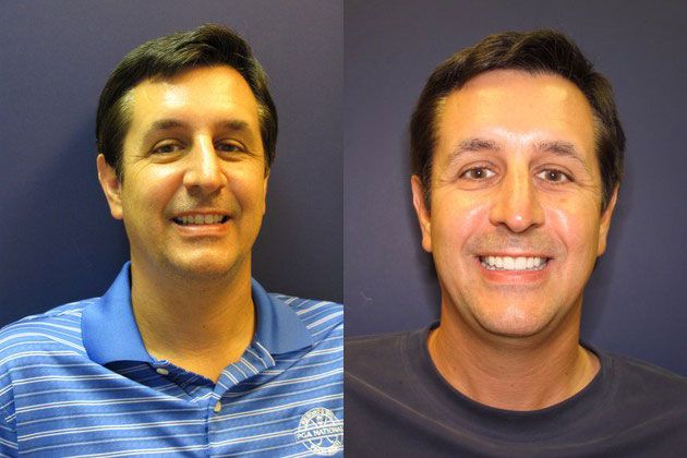 Cosmetic Porcelain Veneers: Multiple units fix crooked and chipped teeth
