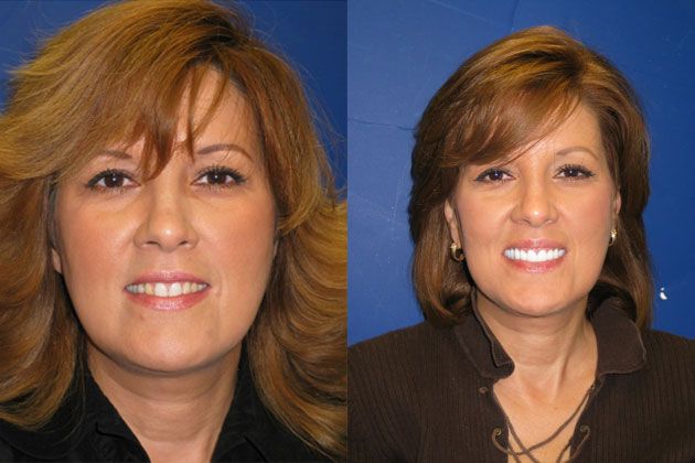 Smile Makeover / Smile Lift : Porcelain Crowns & Cosmetic Porcelain Veneers