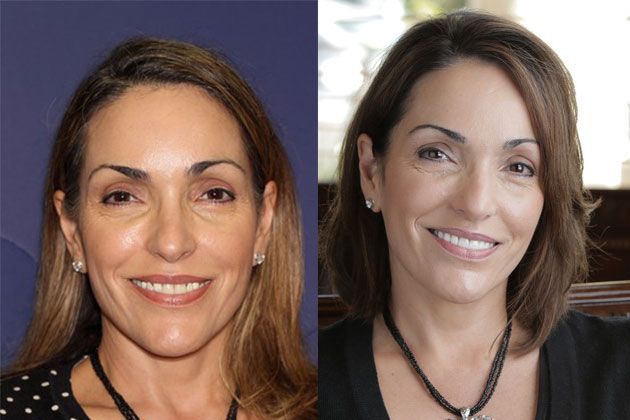 Porcelain Dental Crowns: Cosmetic Porcelain Crowns