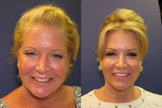 Cosmetic Porcelain Veneers: Pretty smile with more lip fullness