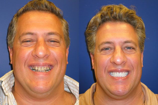 Cosmetic Porcelain Veneers: Porcelain Veneers Smile Makeover
