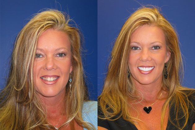 Cosmetic Porcelain Veneers: Porcelain Veneers, Smile Makover with Laser Gum Contouring