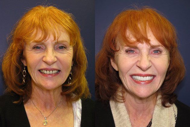 Full Mouth Restoration: Replace failing porcelain to metal crowns