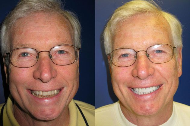 Cosmetic Porcelain Veneers: Replacing low quality Veneers with EMAX
