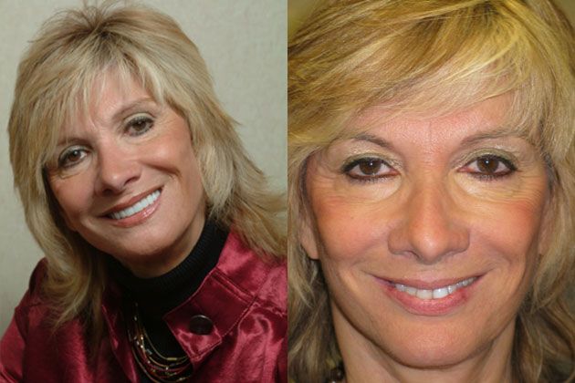 Porcelain Dental Crowns: Cosmetic Porcelain Crowns