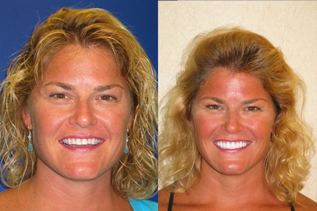 Smile Makeover / Smile Lift : Smile Lift with Empress Porcelain Veneers