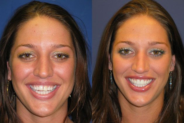 Smile Makeover / Smile Lift : Ultra Thin Cosmetic Porcelain Veneers