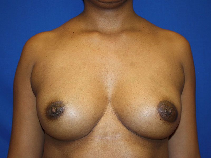 Breast Augmentation Before