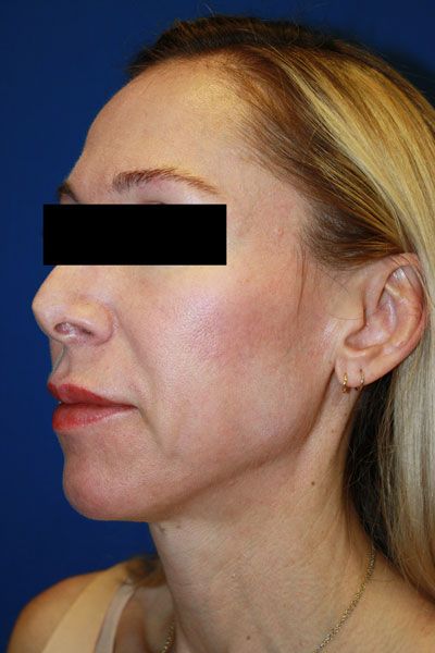 Laser Resurfacing After