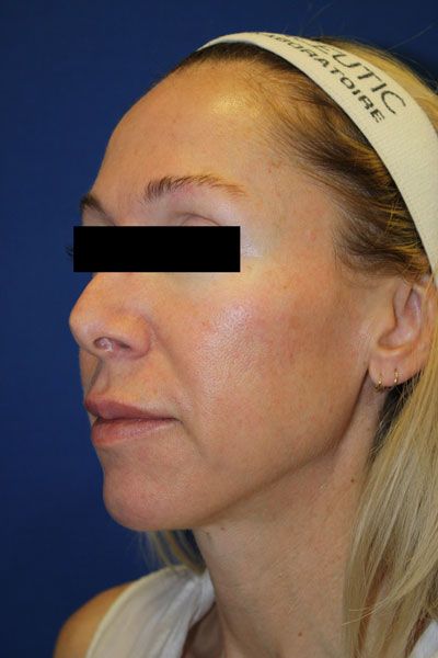 Laser Resurfacing Before