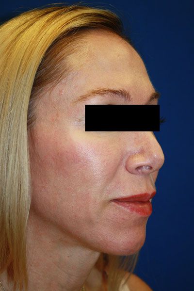 Laser Resurfacing After