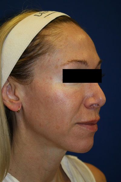 Laser Resurfacing Before