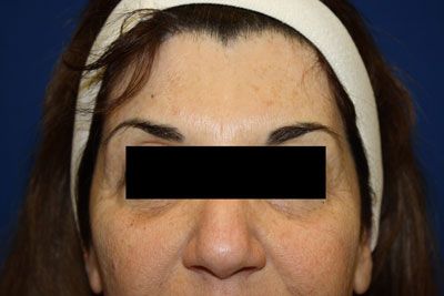 Laser Resurfacing Before