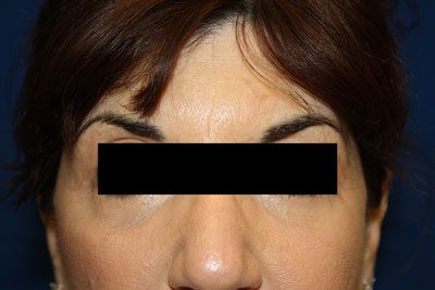 Laser Resurfacing After