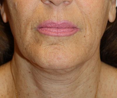 Laser Resurfacing Before