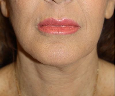 Laser Resurfacing After