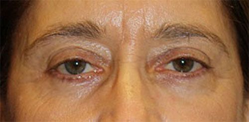 Blepharoplasty After