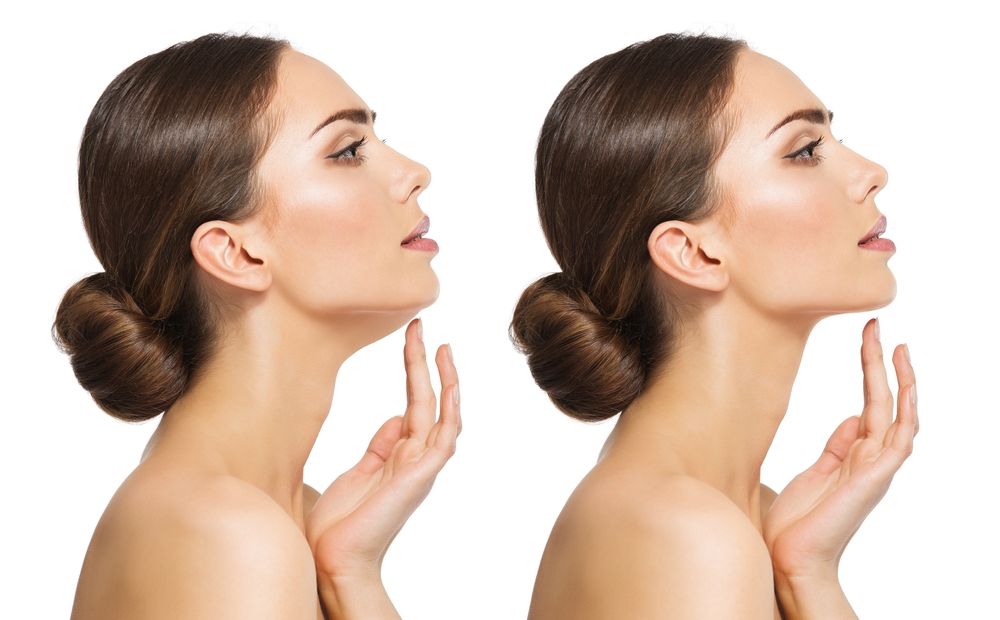 Neck Lift Surgery: Is It Time to Address Sagging and Banding?